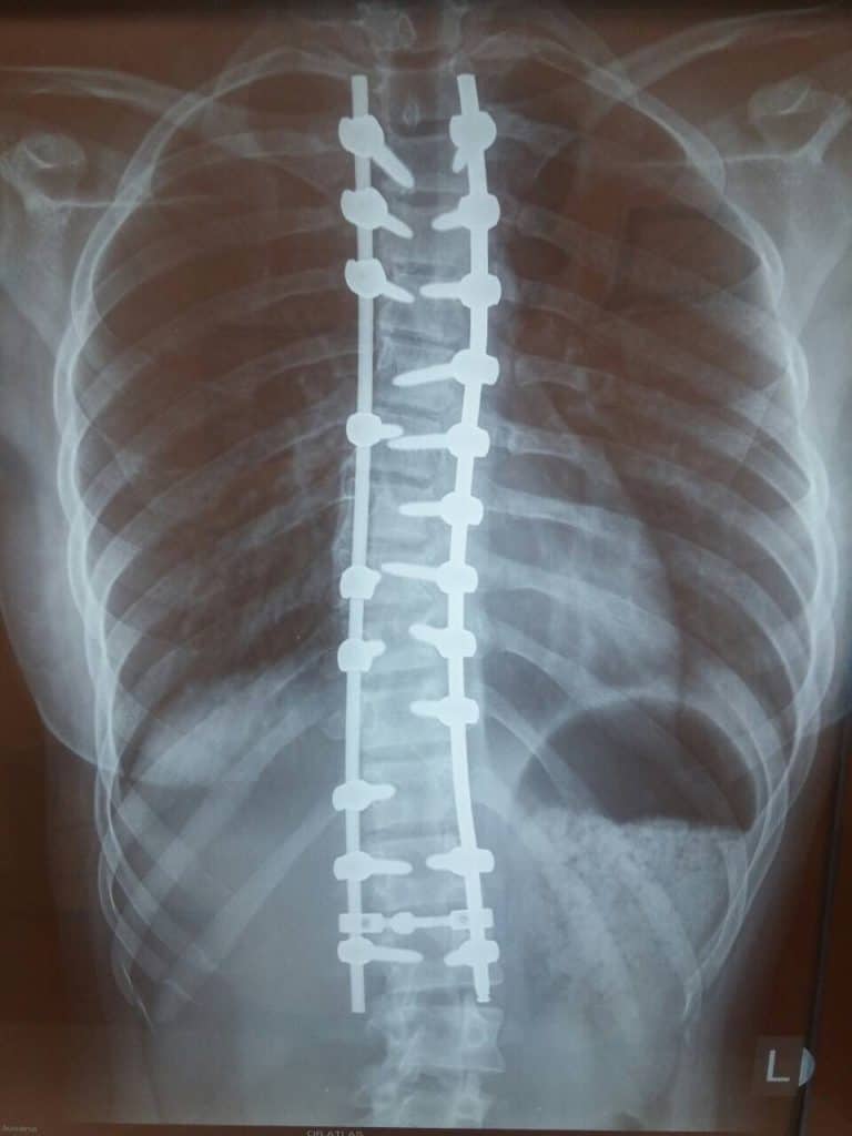 skolioza-posle-operacije skolioza posle operacije