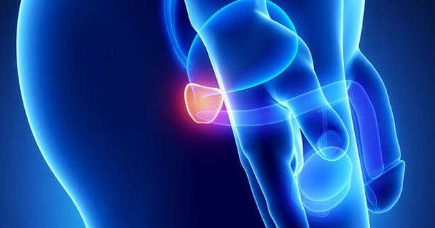 tumor benigno prostata sintomas