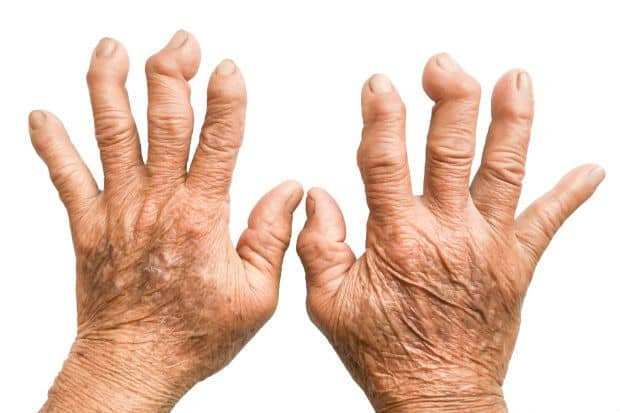 artritis artritis dijagnoza i liječenje)