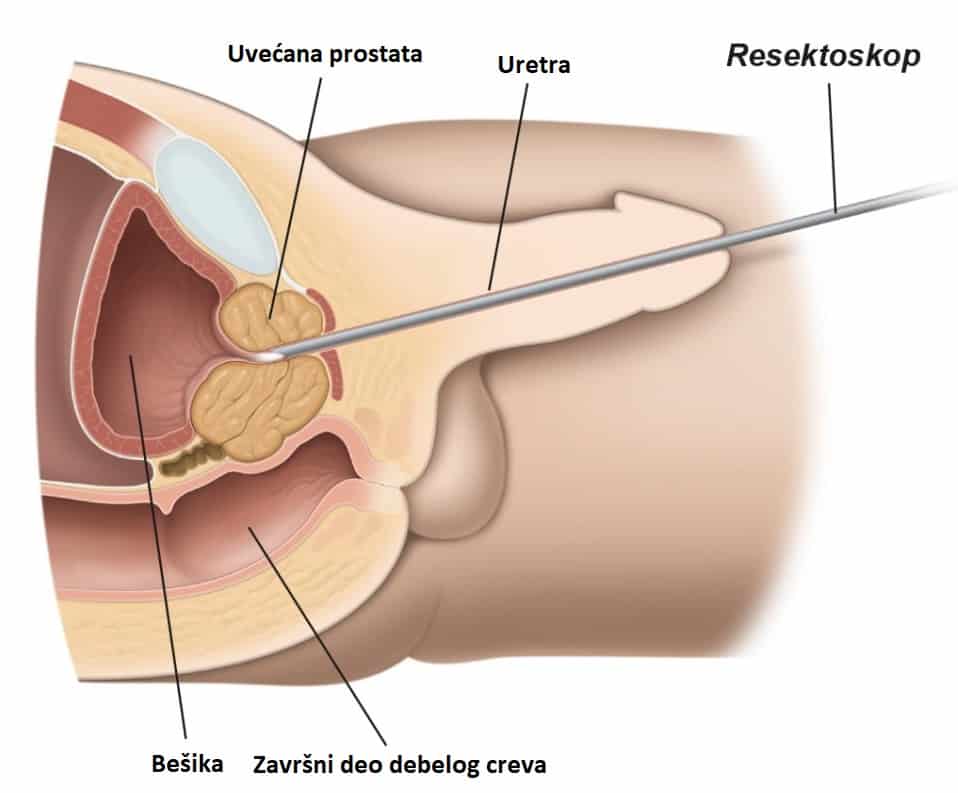 Transuretral Prosztate reszekció rákra Gyertyák Prostatitis Prostatalén és vélemények