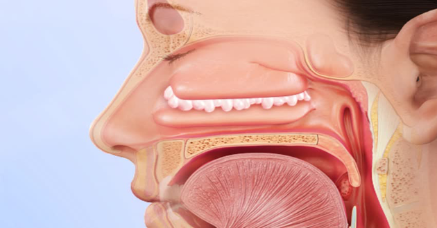 polyps in nasal cavity