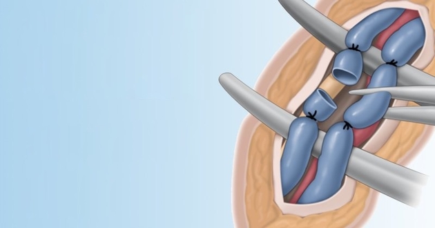 Simptomele și tratamentul varicelor scrotului fără intervenții chirurgicale